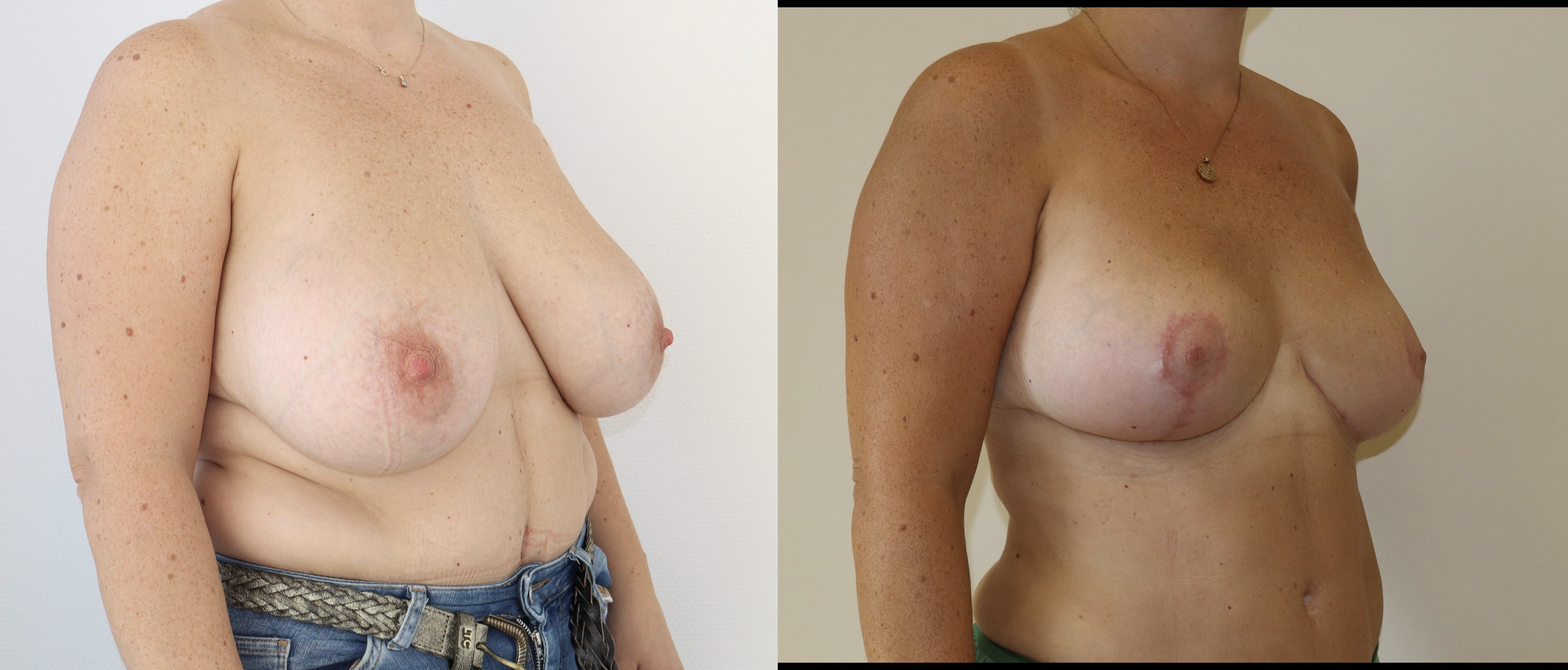 Avant/Après lifting seins et réduction mammaire